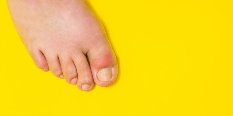 ダニに刺されて指が一本だけ腫れた…これ何？調べてわかった原因